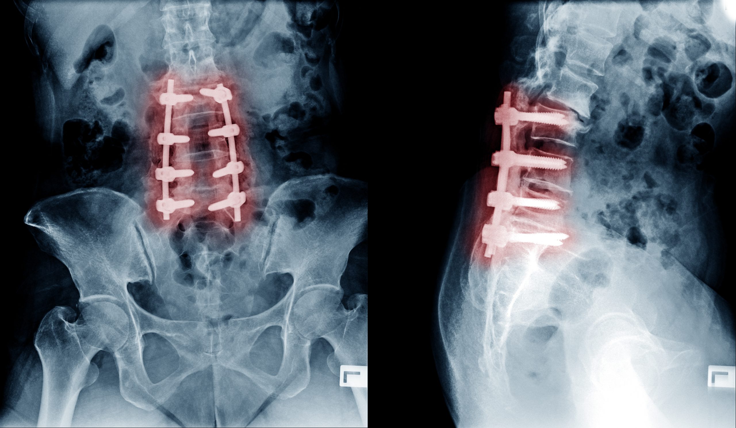 what-is-the-average-settlement-for-a-lumbar-fusion-workers-comp